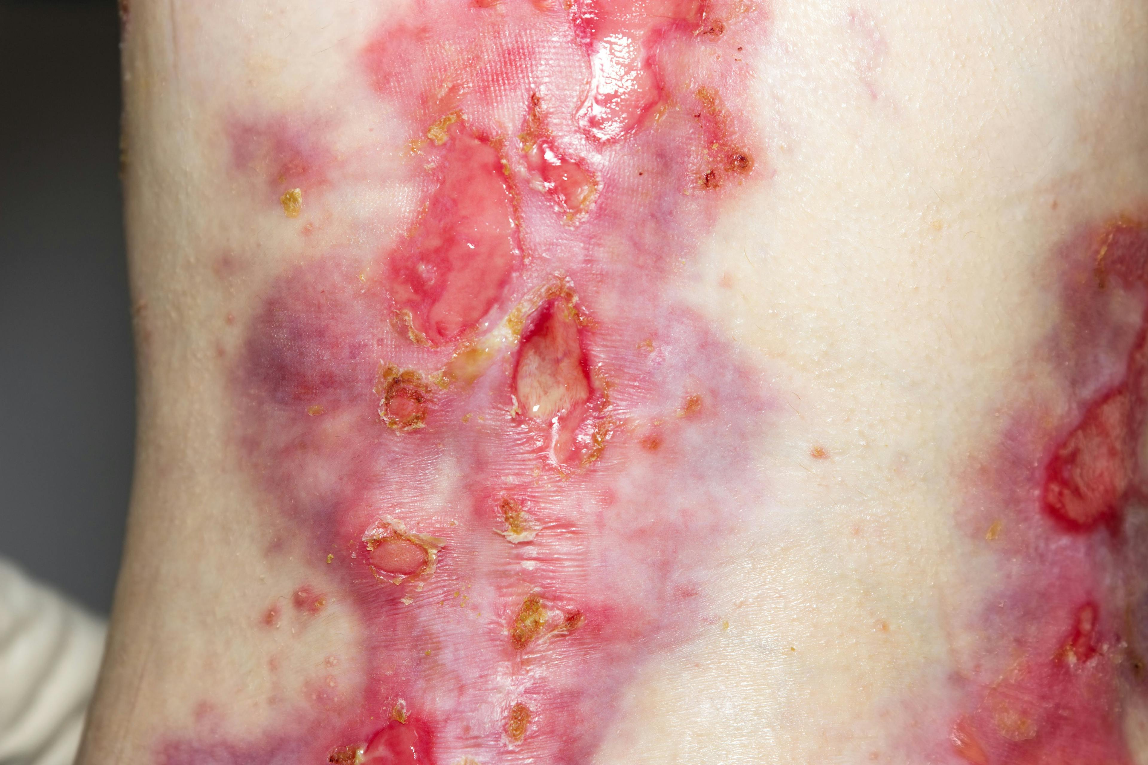 FDA Approves Topical for Rare Skin Disorder