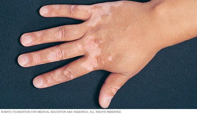 FDA Approves Opzelura for Skin Condition