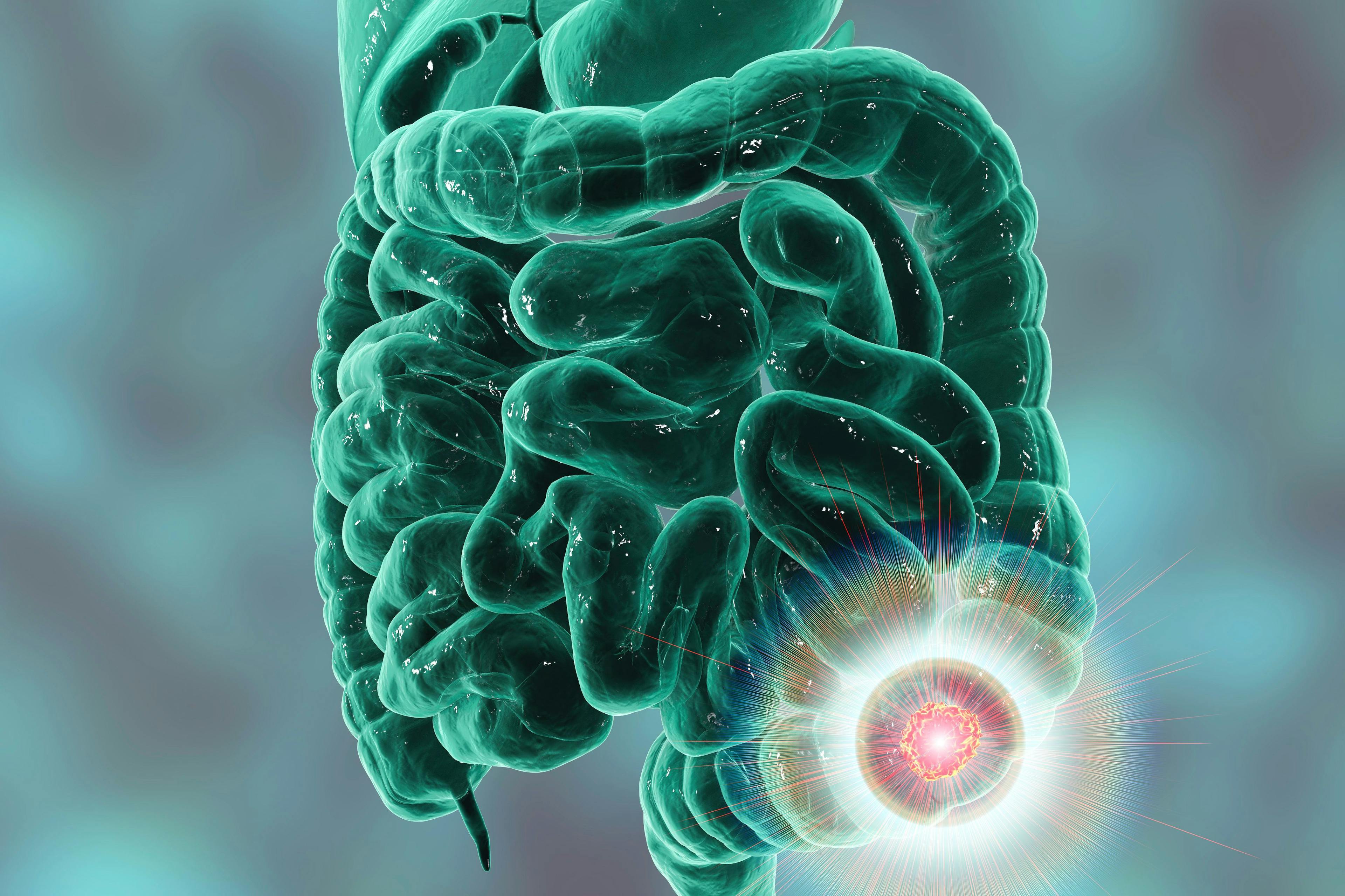 FDA Approves Oral Therapy for Metastatic Colorectal Cancer