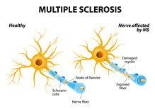 ICER: Monoclonal Antibodies Not Cost-Effective in Multiple Sclerosis