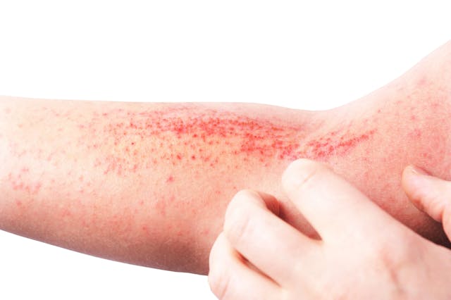 FDA Issues CRL for Lebrikizumab in Atopic Dermatitis