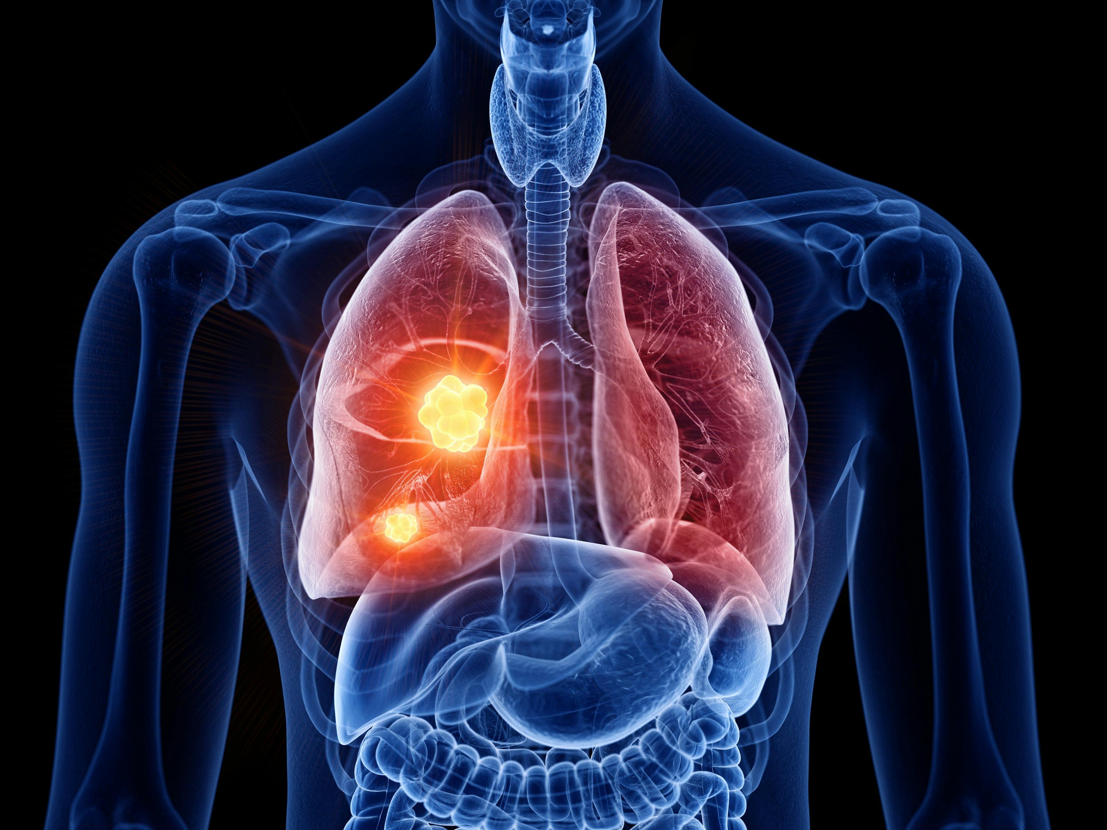 New lung cancer treatment launches