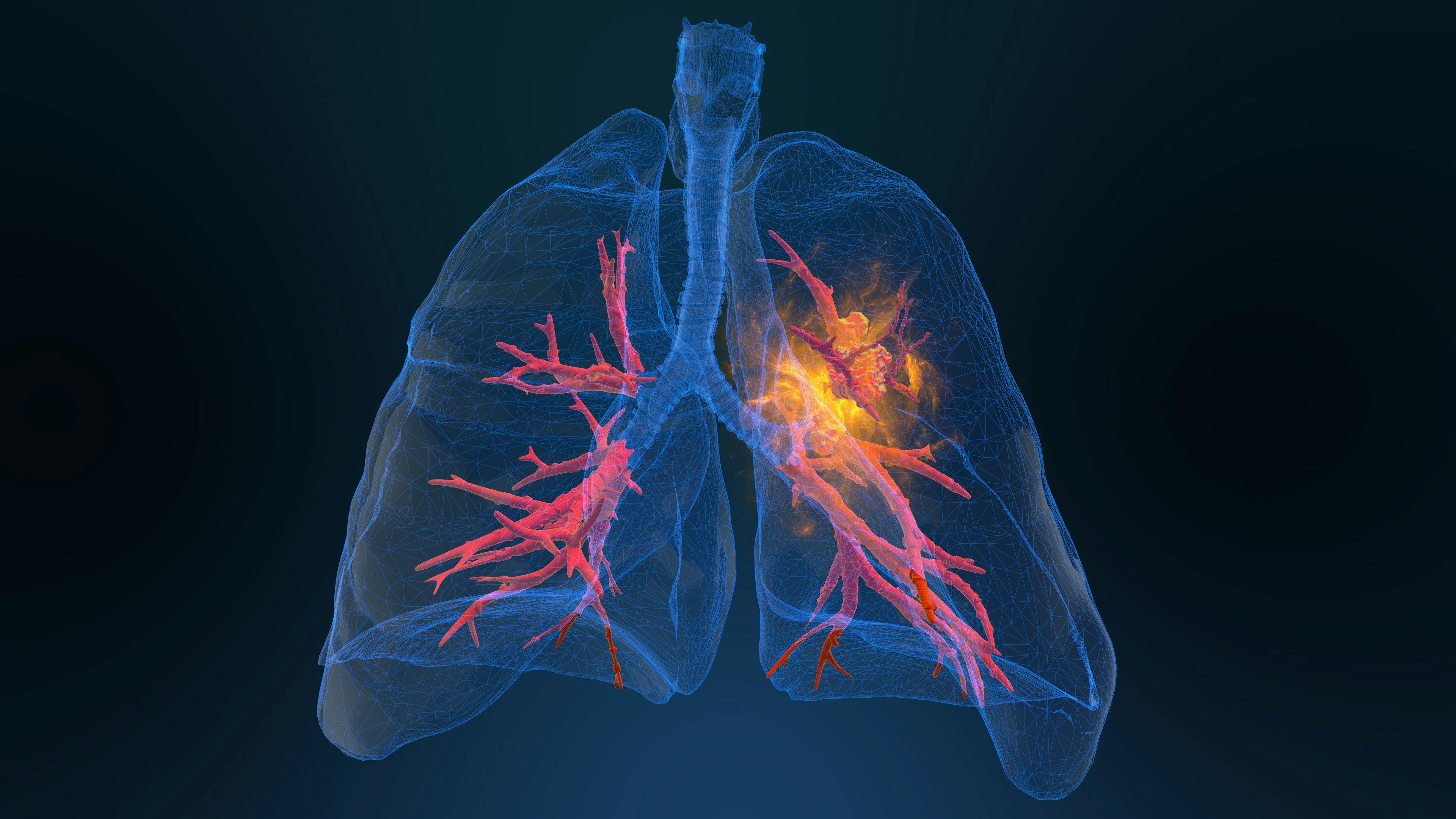FDA Approves Augtyro to Treat ROS1 Positive Lung Cancer