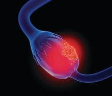 FDA Accepts BLA for Mirvetuximab Soravtansine for Ovarian Cancer