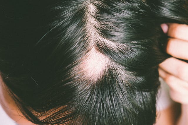 FDA Approves Pfizer’s Alopecia Drug