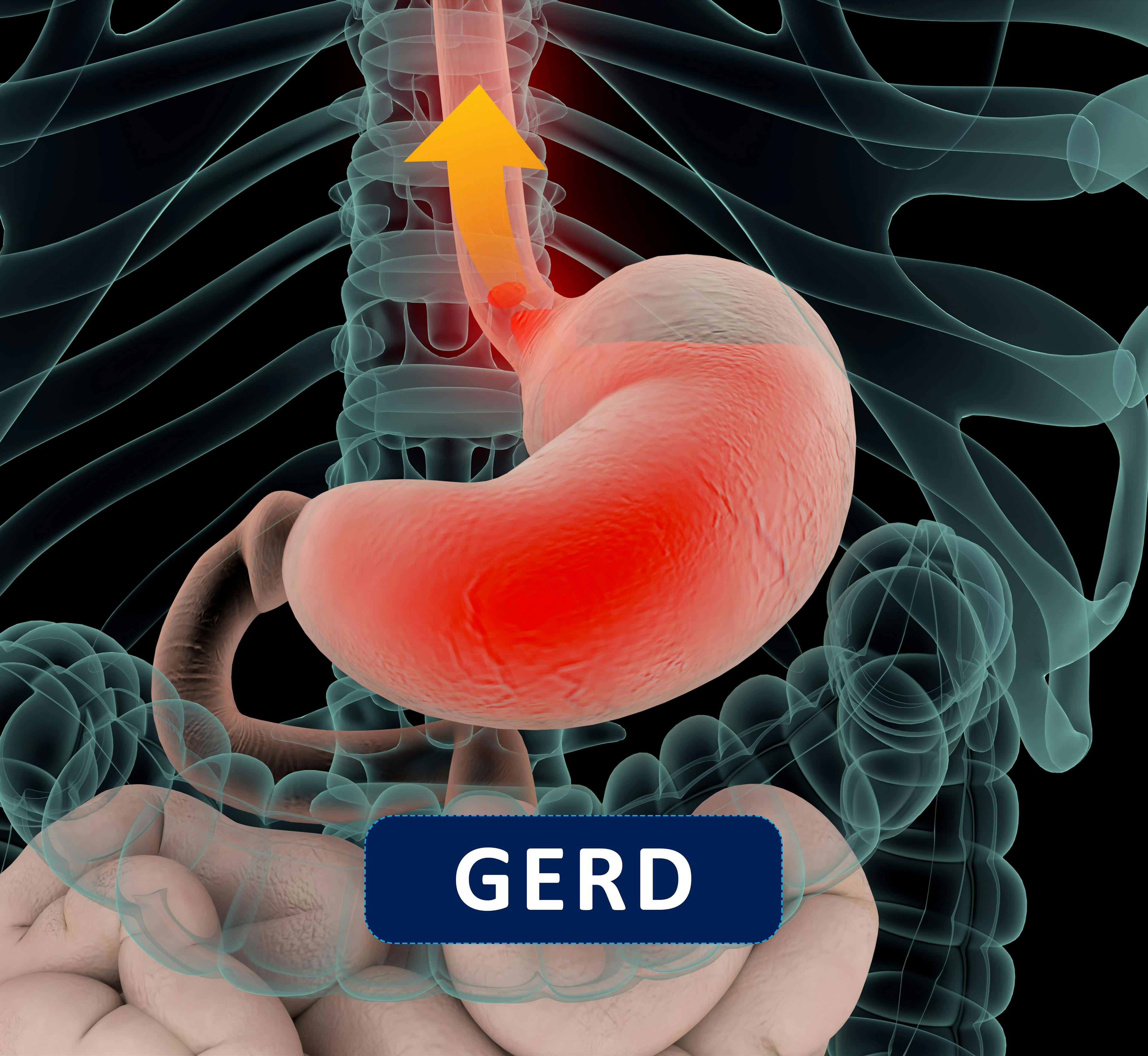 FDA Approves Novel Therapy for Gastroesophageal Reflux