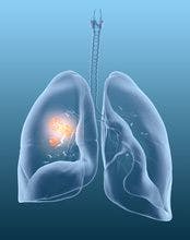 FDA Issues CRL for Poziotinib for Lung Cancer