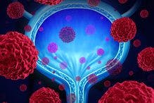 FDA Accepts BLA for Immunotherapy for Bladder Cancer