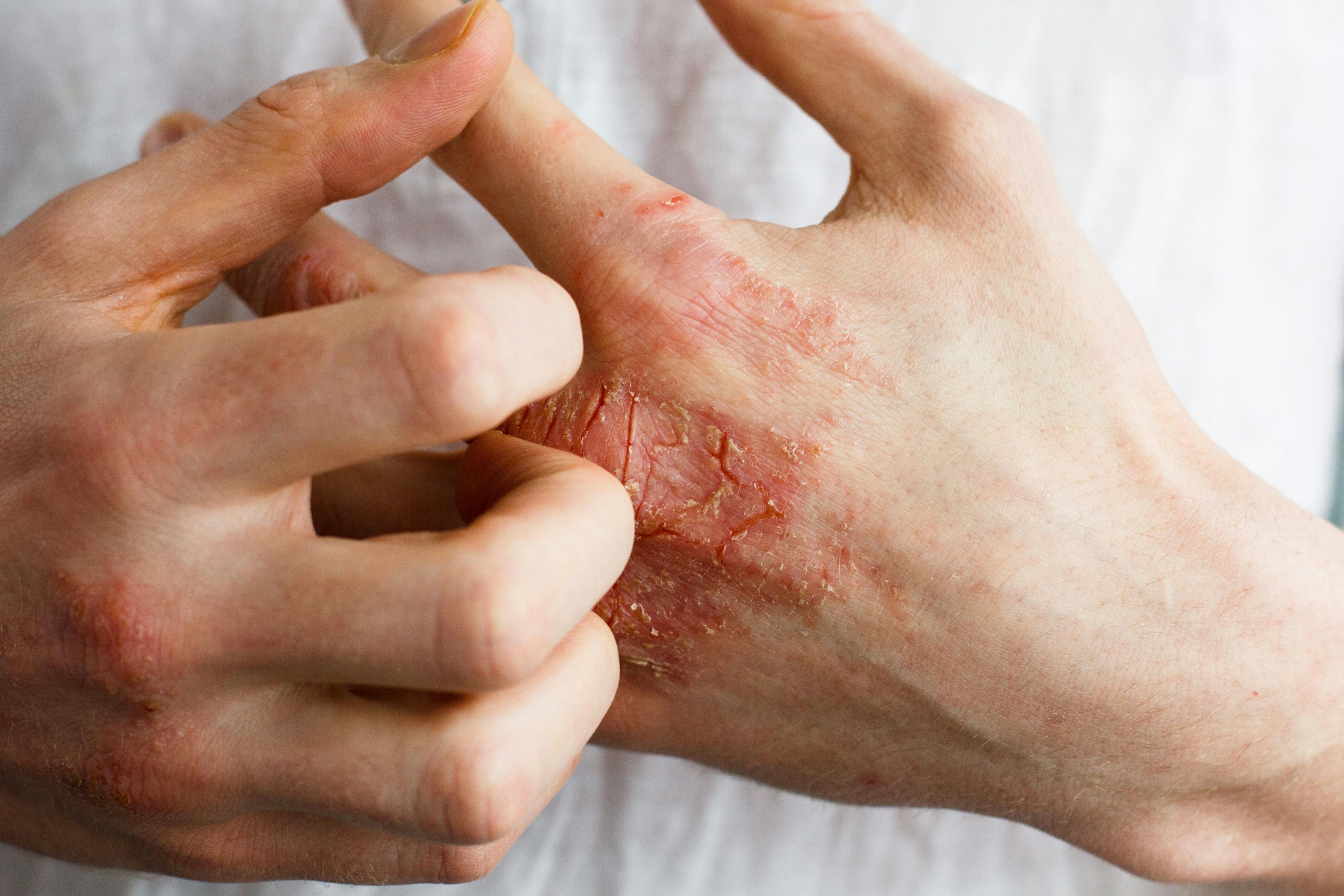 Dupixent Has Company. The FDA Has Approved Another Biologic for the Treatment of Atopic Dermatitis.