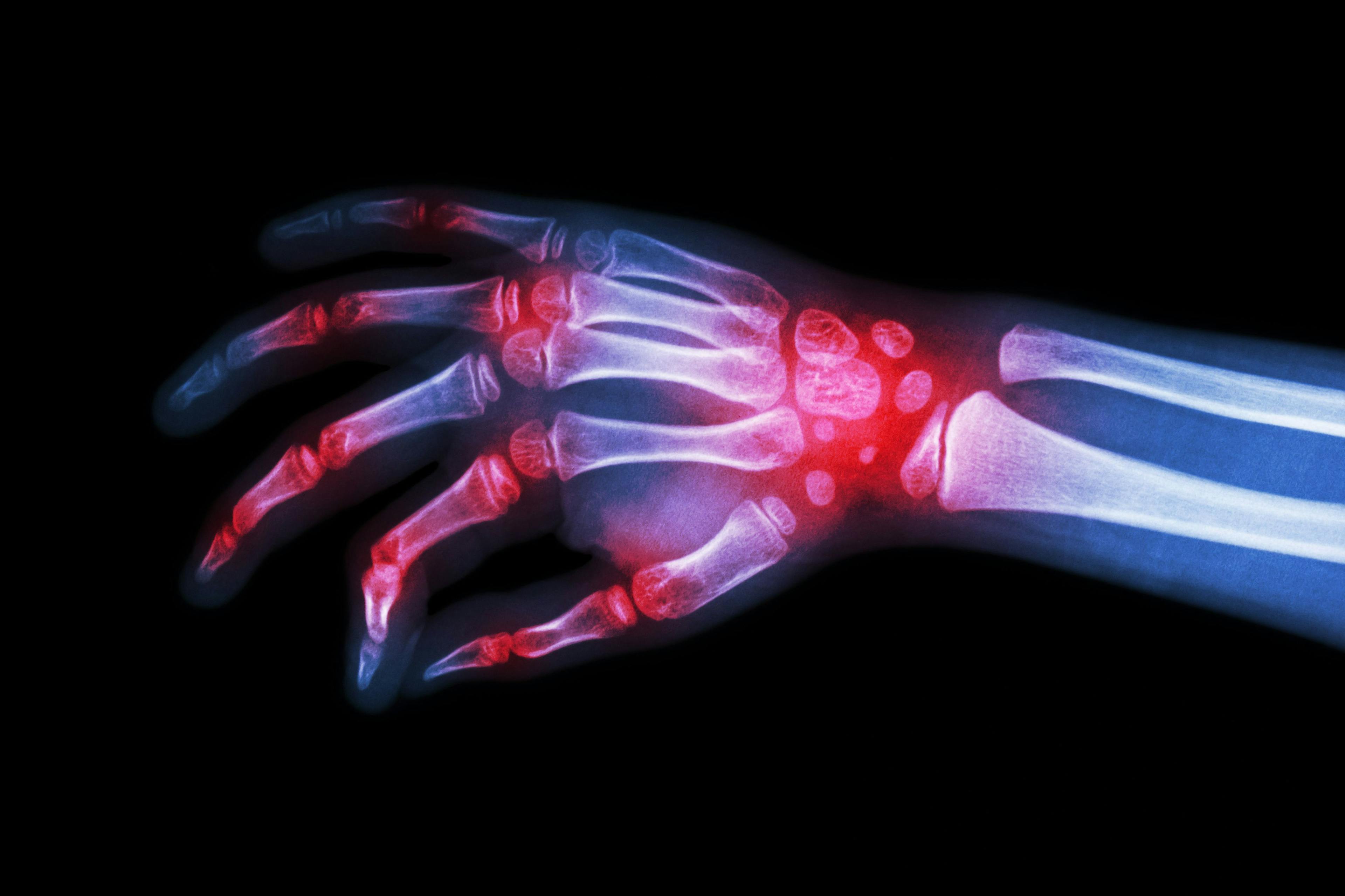 FDA Approves First Biosimilar of Arthritis Med Actemra