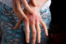 Novel Psoriasis Therapy to be Submitted to FDA 