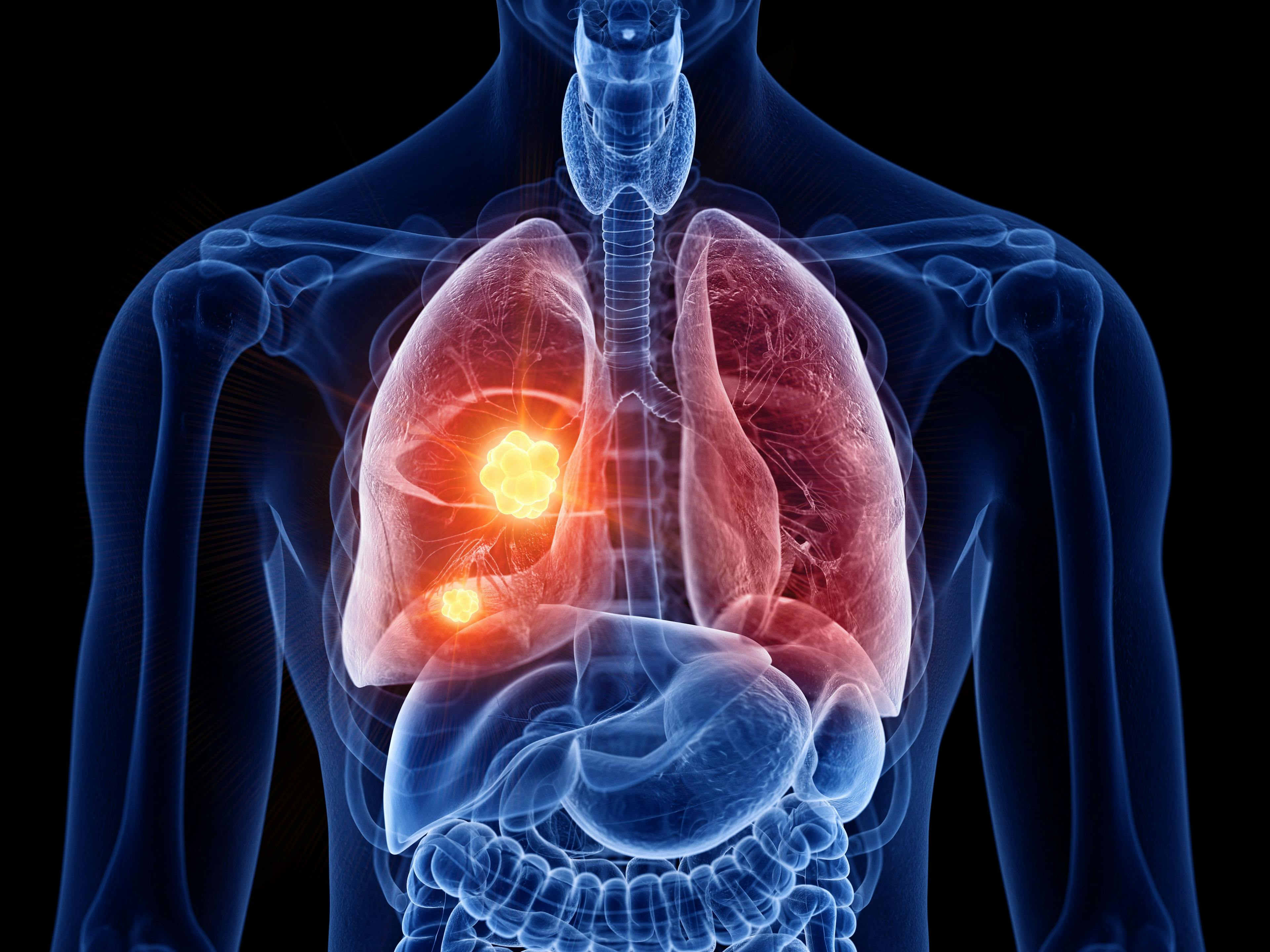 FDA OKs first targeted therapy for lung cancer with certain type of EGFR mutations
