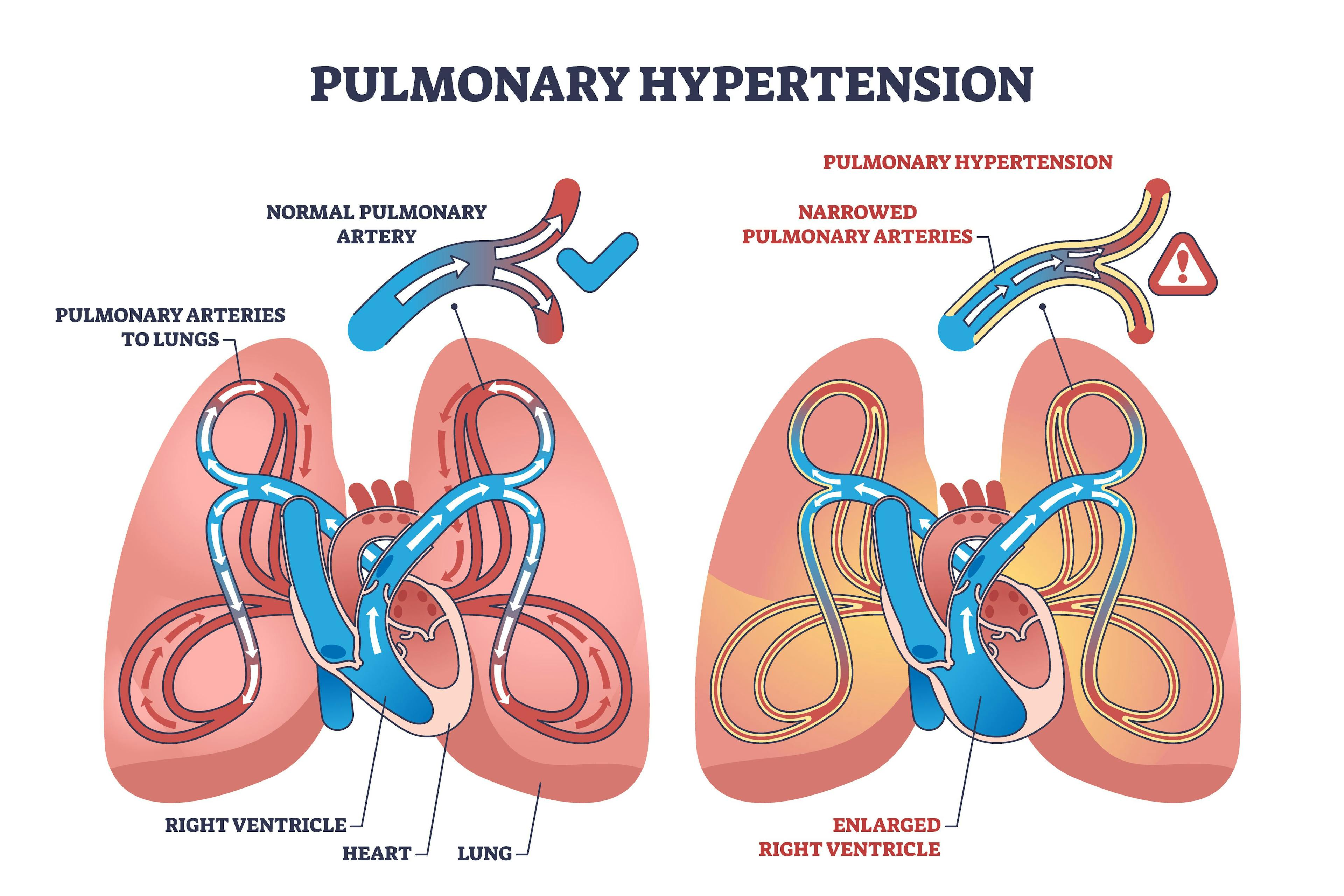 FDA Approves Combination Therapy for Pulmonary Arterial Hypertension