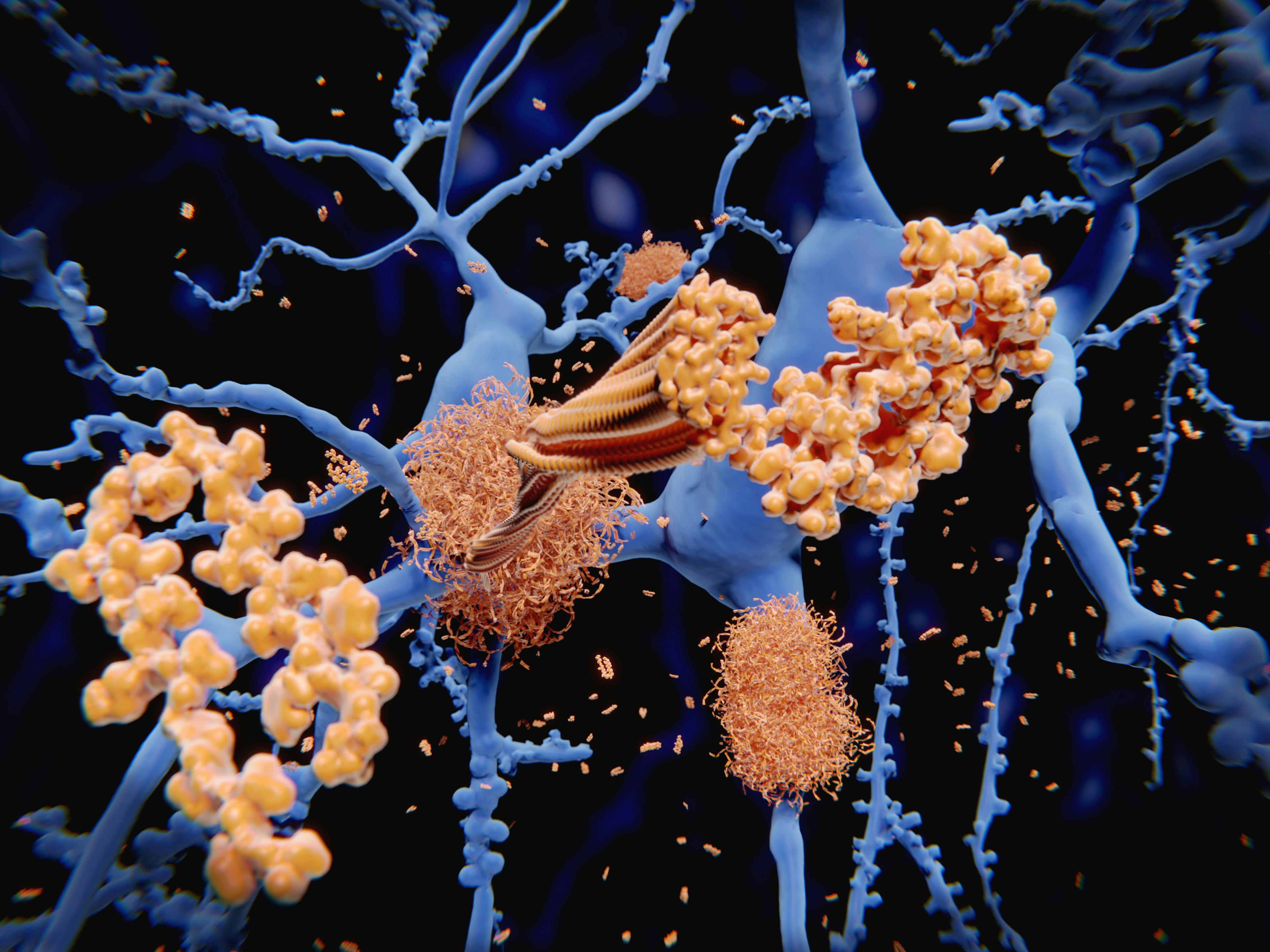 ICER To Assess Aduhelm, Other Monoclonal Antibody Treatments for Alzheimer's  in 2022